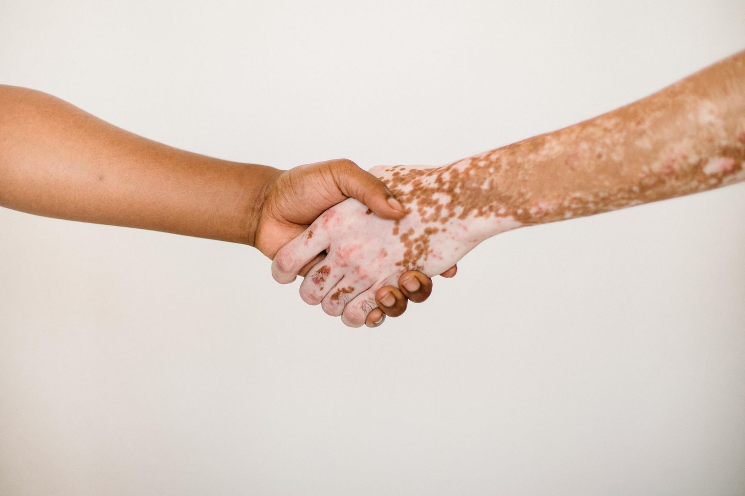 Crop anonymous man shaking hand of male friend with vitiligo skin against white background